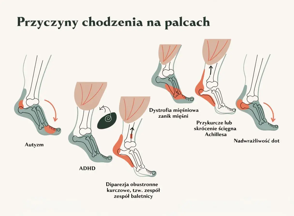 Ilustracja pokazuje, że dziecko chodzi na palcach z różnych powodów: autyzm, ADHD, dystrofia mięśniowa, przykurcz ścięgna Achillesa, dipareza kurczowa i nadwrażliwość dotykowa.
