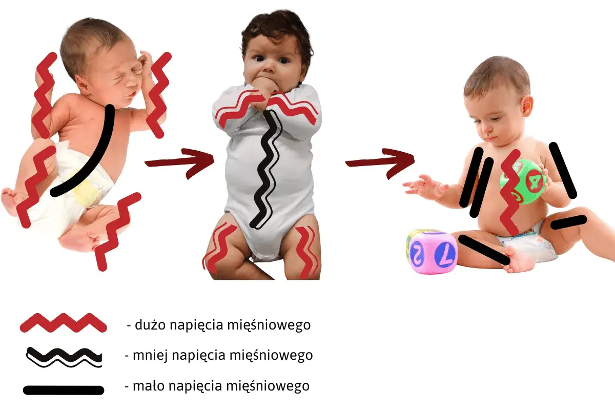 Zmiana napięcia mięśniowego u noworodka: od dużego napięcia (czerwone zygzaki) do mniejszego (czarne fale) i małego (czarne linie).