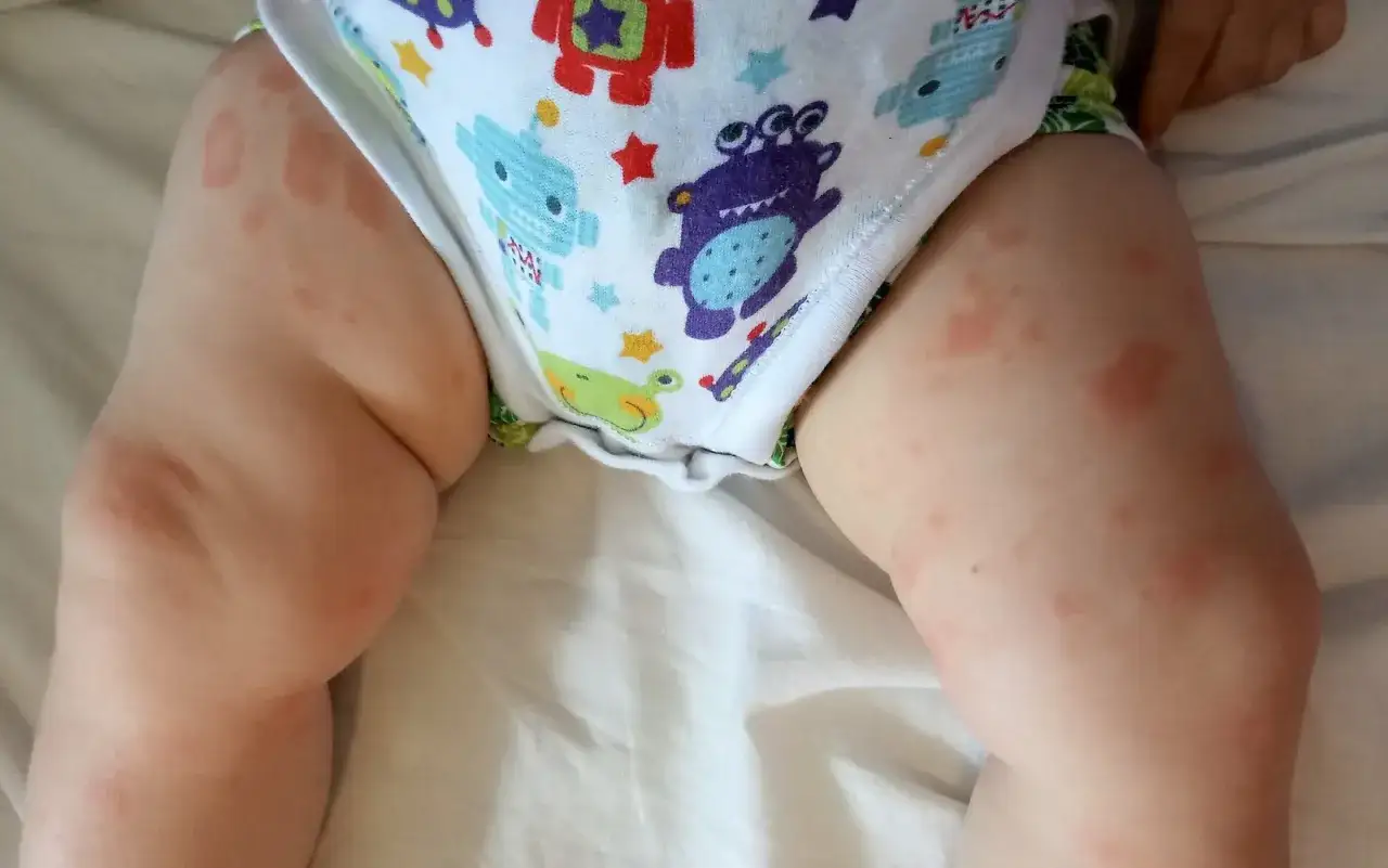 Czerwone plamy na skórze dziecka, widoczne na udach i w okolicach pieluszki, mogą wskazywać na alergię na BMK.